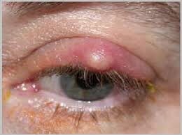 Cara Menghilangkan Benjolan Di Kelopak Mata